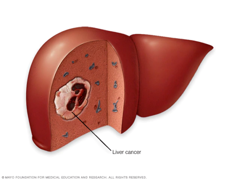 Navigating the Landscape of Hepatobiliary Cancer: Understanding, Diagnosis, and Treatment.