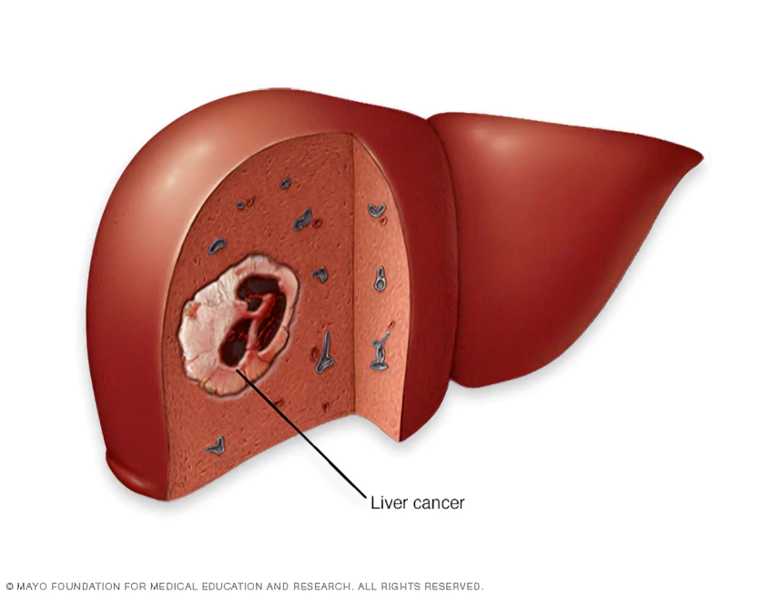 Best Breast Cancer Treatment in Ashok Vihar