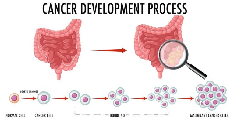 How to Choose the Right Treatment for Stomach Cancer.